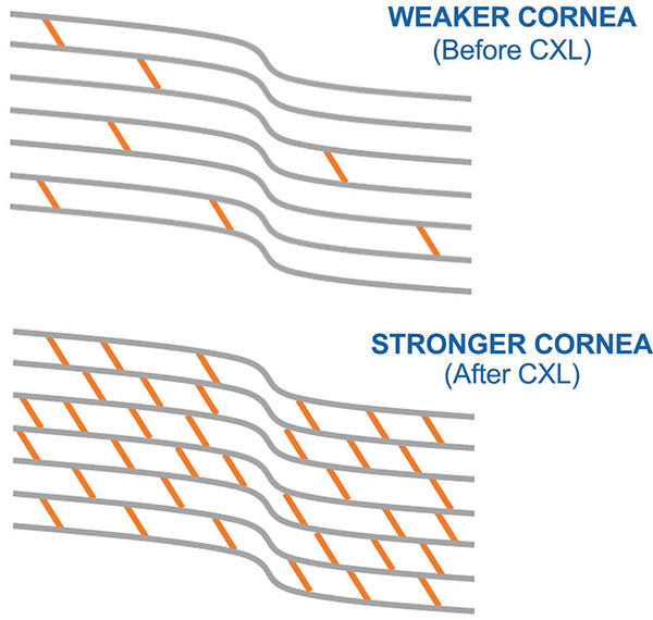 Chart Illustrating a Weaker Cornea Compared to a Stronger One After Cornea Cross-Linking