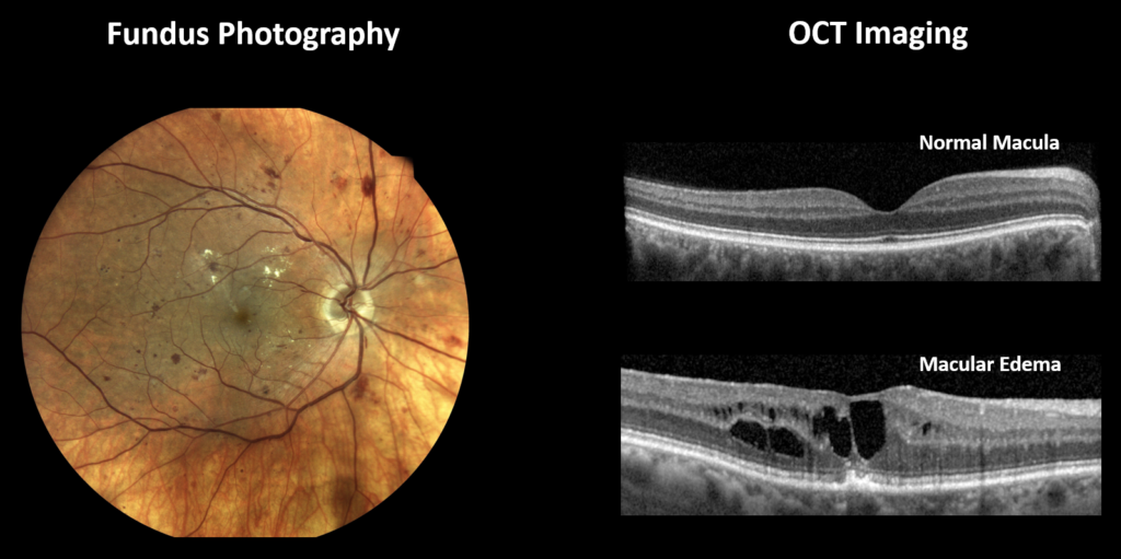 Fundus Photography vs OCT Imaging