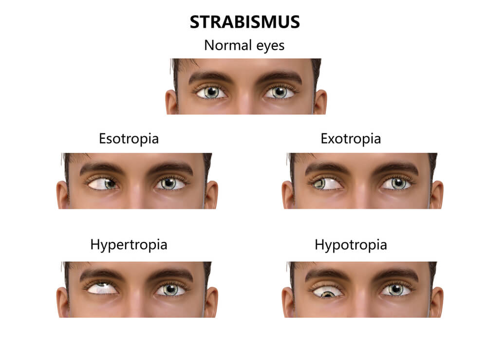 Diagram showing forms of strabismus: inward (esotropia), outward (exotropia), upward (hypertropia), or downward (hypotropia).