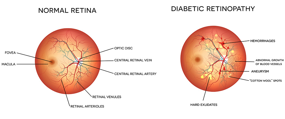 Chart Showing a Healthy Eye Compared to One With Diabetic Retinopathy