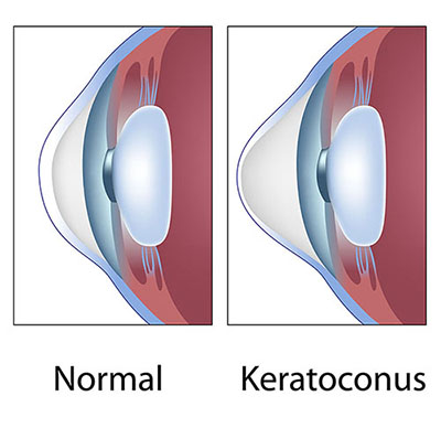 Chart Illustrating a Normal Eye Compared to One With Keratoconus